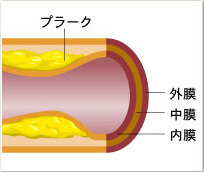 動脈硬化の血管断面